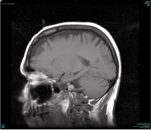 MRI image of consciousness leaving the crown of Zhaxi Zhuoma